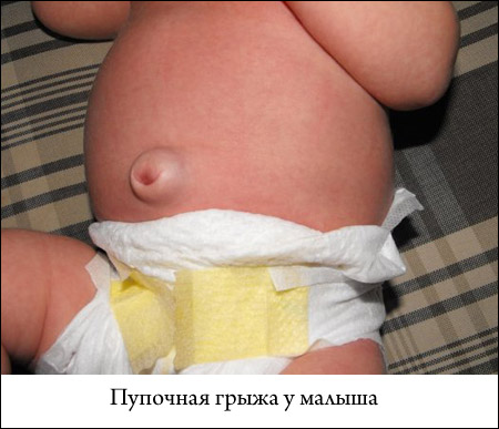 Пупочная грыжа