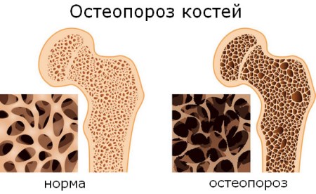 Остеопороз у женщин
